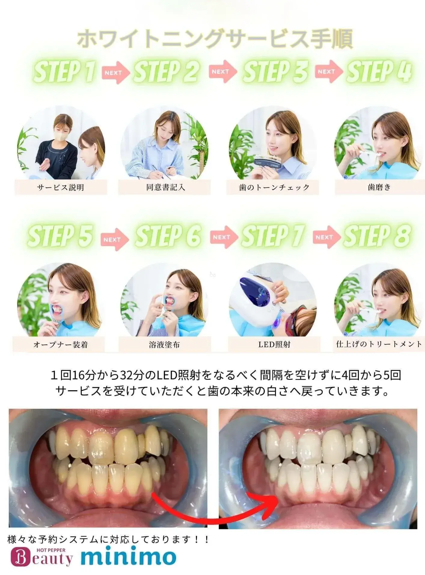ホワイトニングの手順